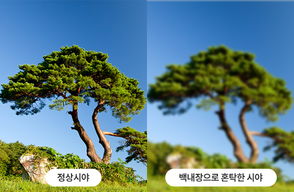 정상 수정체와 백내장 수정체 비교 이미지