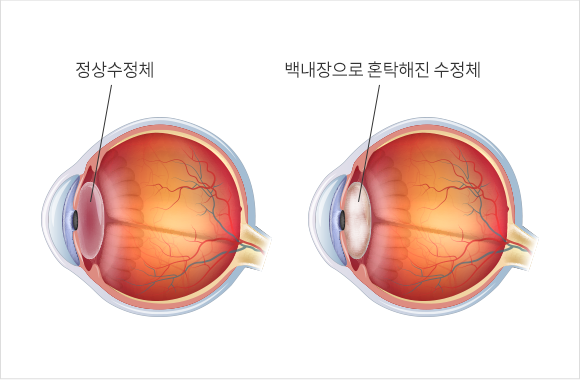 백내장 증상 설명 이미지