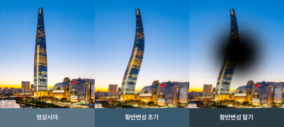 황반변성 안내 이미지