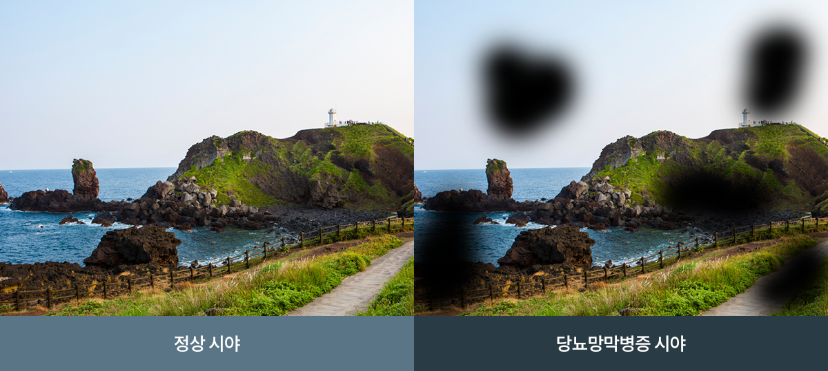 당뇨망막병증 안내 이미지